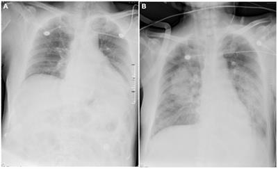 Extracorporeal membrane oxygenation in acute respiratory distress syndrome caused by elderly tuberculous meningitis: a case report and review of the literature